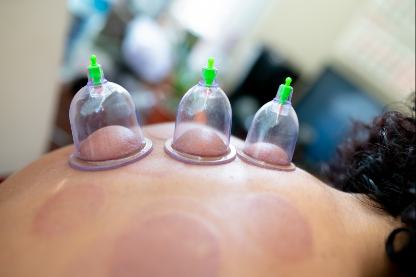 Hijama certifiée Tétouan thérapie ventouses