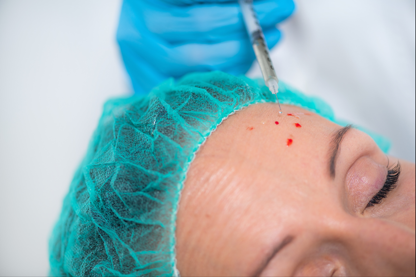 PRP visage Tétouan vampire facial